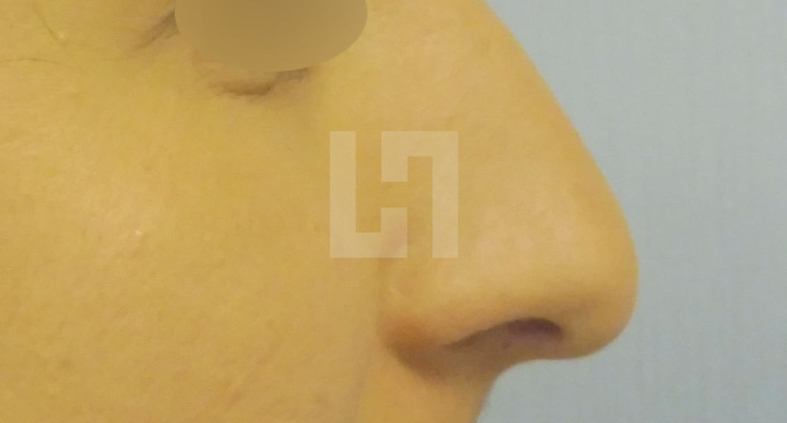 avant-rhinoplastie-esthetique-153-dr-hanan