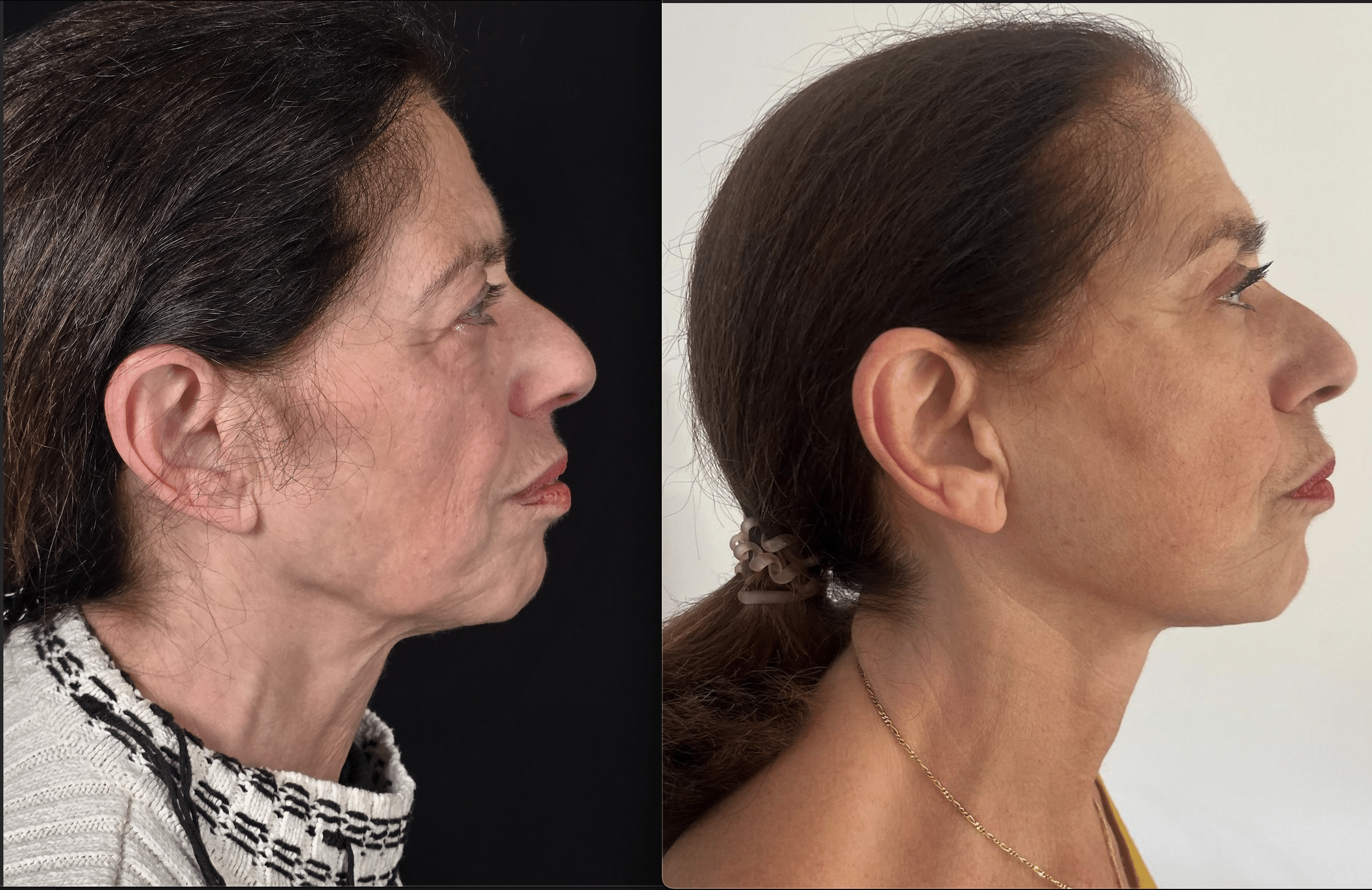 Here is an example of a deep plane facelift result with blepharoplasty