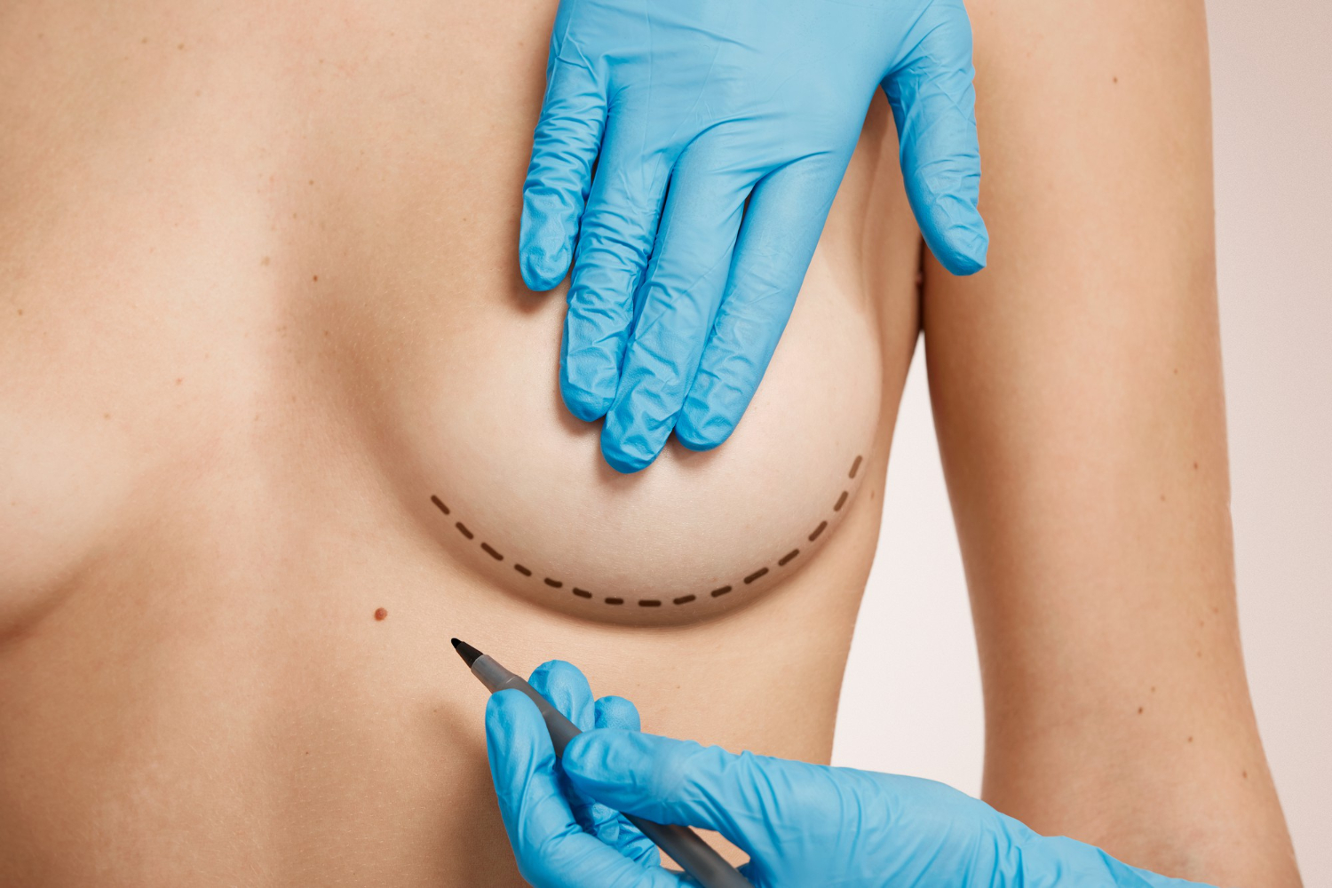 What is the Best Age for Breast Reduction Surgery